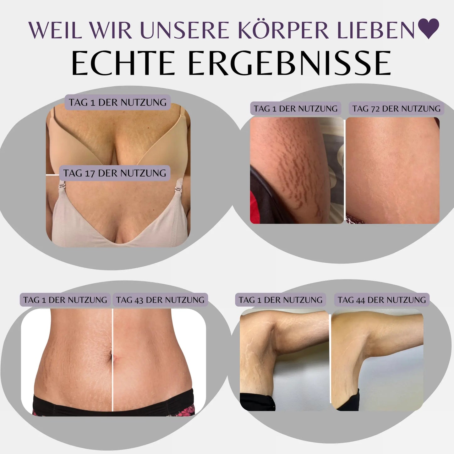 Sanlivna™ Dehnungsstreifen Serum 100ml